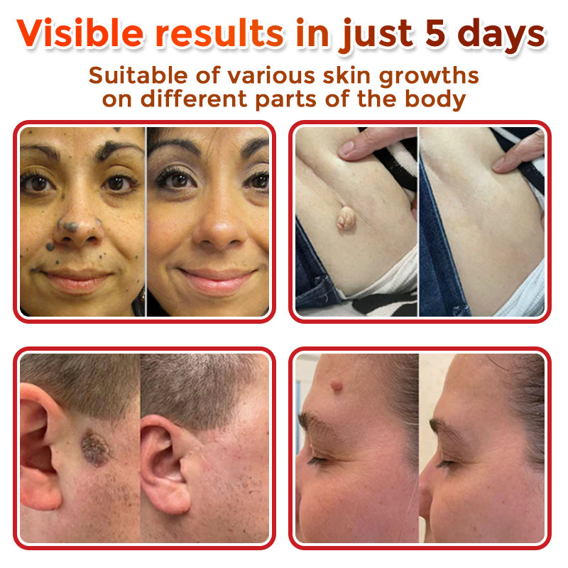 🌈 SkinPrikyn™ MicroNeedle Botanic Skin Tag Removal Patch 🇺🇸 Made in the USA