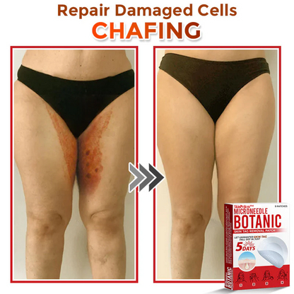🌈 SkinPrikyn™ MicroNeedle Botanic Skin Tag Removal Patch 🇺🇸 Made in the USA
